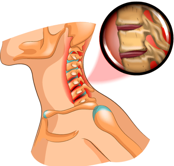 neck osteochondrosis