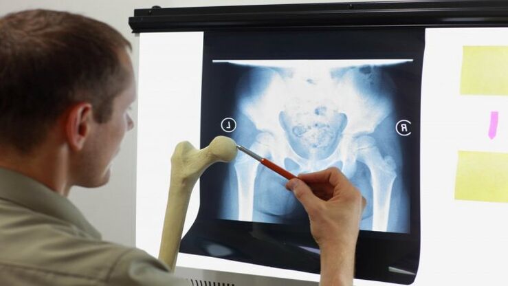 Doctor examines an x-ray for hip osteoarthritis
