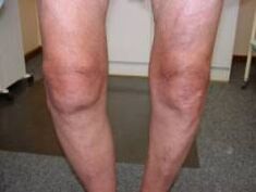 Symptoms of osteoarthritis of the knee joint